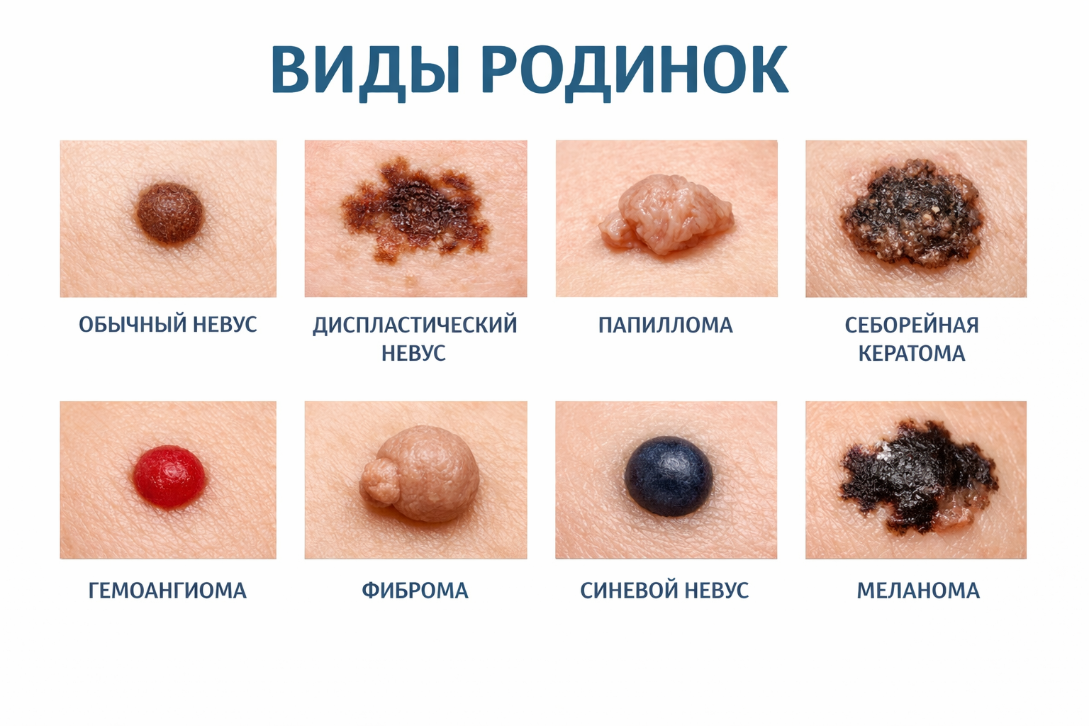 ддиагностика родинок