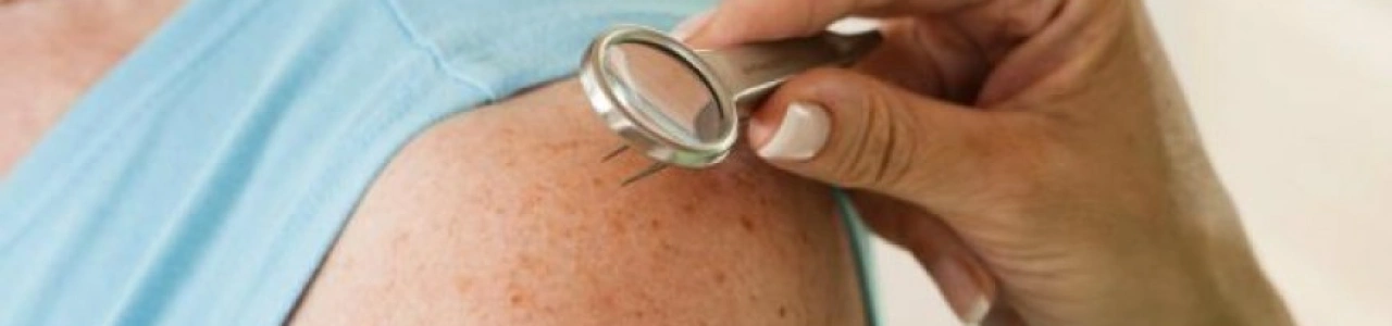 Чего ждать после удаления родинки лазером