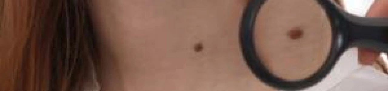 Разновидности новообразований на коже