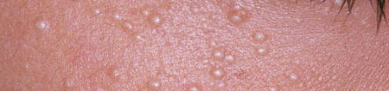 Милиумы: причины и способы удаления