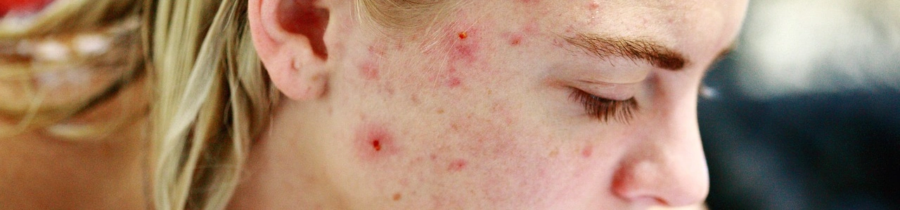 Избавляемся от постакне: метод профессионалов