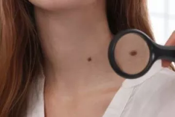 Різновиди новоутворень на шкірі