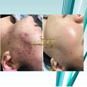 чистка лица