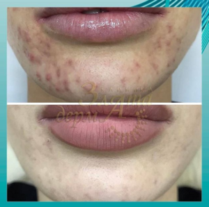 лечение акне