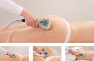 процедура эксилис