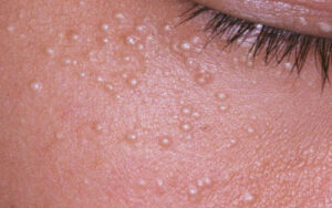 милиумы удаление