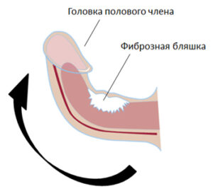 искривление пениса