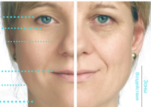 спейслифтинг хирурги