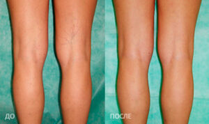 склеропатия отзывы