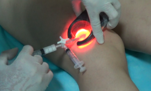 склеропатия