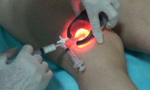 склеропатия