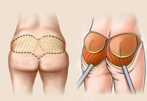 увеличение ягодиц имплантатами