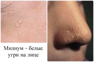 удаление милиум