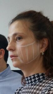 ультрозвуковой лифтинг фото