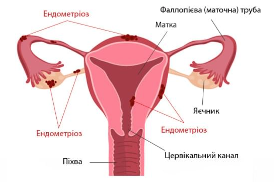 Лечение эндометриоза в Николаеве
