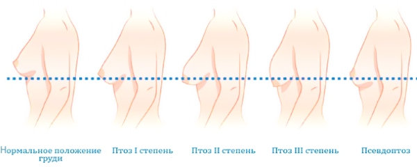 птоз-груди