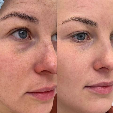 лечение пигментных пятен